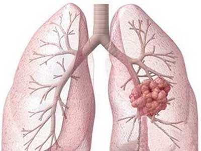 重庆中医可以治疗肺癌晚期吗