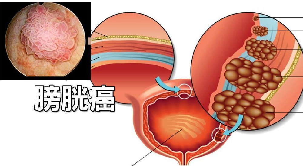 重庆中医多久可以治好膀胱癌