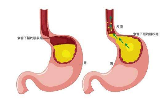 肿瘤专家石毓斌:为什么会得胃癌？实际上是幽门螺杆菌感染！