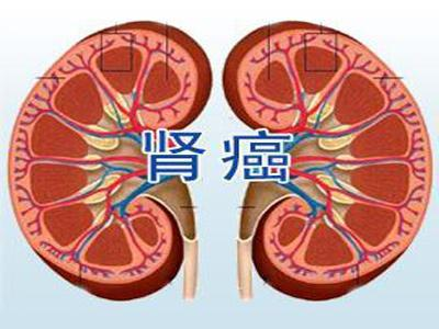 中医罗登祥治疗肾癌贵不贵?杏林高手,杏林春满