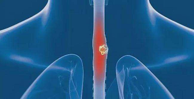 重庆中医肿瘤医师:别拿食道癌当做咽炎,这些习惯就是在招惹“它”
