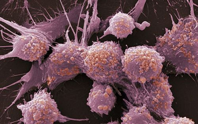 重庆中医肿瘤专家:中医角度是如何理解体内的癌细胞呢?