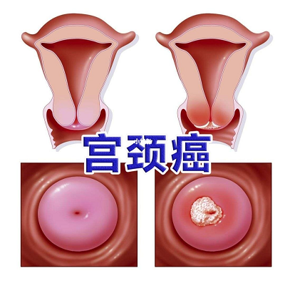 重庆中医肿瘤专家接诊患者提出的宫颈癌问答,建议搜藏