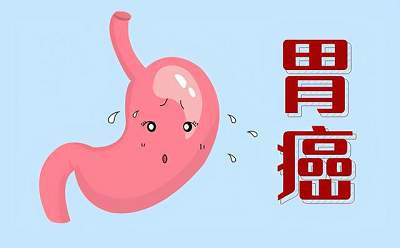 重庆中医肿瘤专家:胃癌已经年轻化,胃癌的早期症状可能不是痛