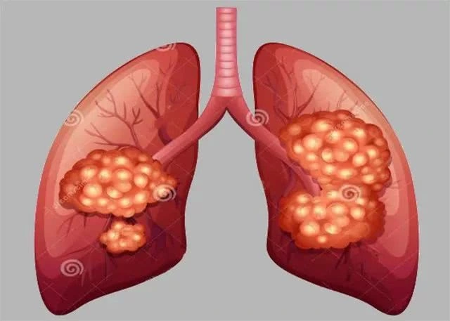 重庆中医肿瘤医馆科普|肺癌不可怕,早期发现很重要