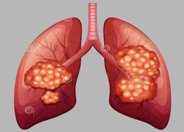 重庆肺癌老中医:只有吸烟才会导致肺癌吗?你错了,还有这些原因
