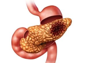 重庆胰腺癌肿瘤中医医师:研究发现胰腺癌还有这些早期症状表现