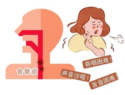 重庆中医肿瘤科医师:食管癌的这七大早期症状表现你一定要了解