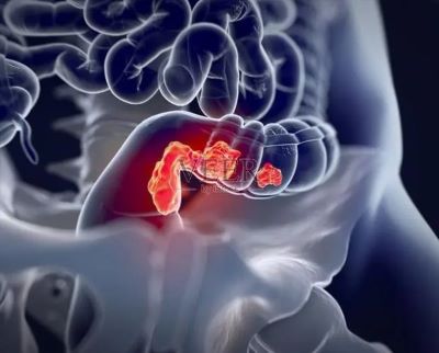 重庆中医肿瘤医师:多吃这几种食物预防结肠癌很重要
