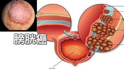 重庆中医肿瘤医院排名|这几个症状不得不防,尤其是尿出血可能是膀胱癌