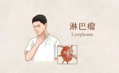 重庆治疗淋巴癌肿瘤老中医:检查淋巴癌有这几种武器就够了