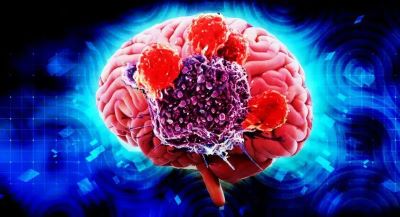 重庆治疗脑癌老中医:牢记脑癌的前以及常见的特征
