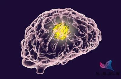 重庆肿瘤科老中医:带你们了解脑癌早期有哪些症状特点