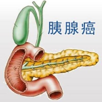 重庆中医肿瘤医师排名|推荐大家如何更有效地预防胰腺癌的方法