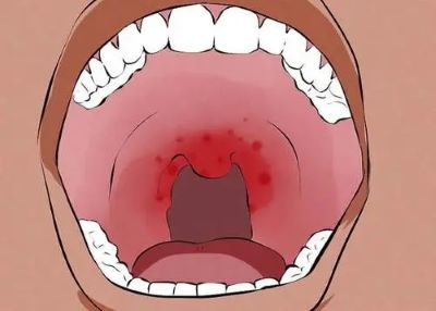 重庆治疗口腔癌老中医:推荐口腔癌患者缓解病情有好处的食物