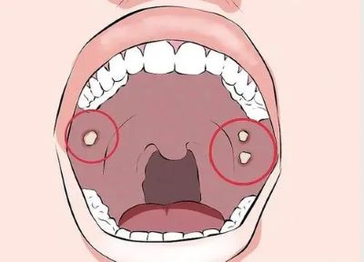 重庆中医肿瘤医馆排名|引起口腔癌的原因是什么,早期又有哪些症状