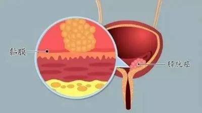 经常憋尿会引发膀胱瘤?看中医医师罗登祥如何辨证治疗膀胱瘤