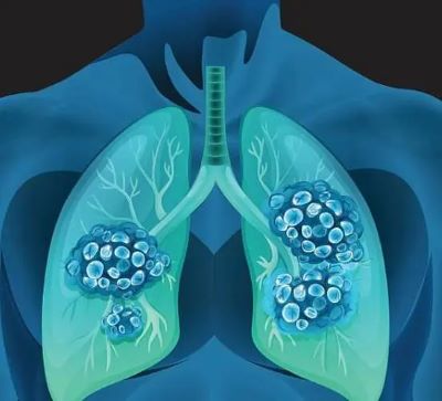 中医对于肺部肿瘤是如何辩证治疗的?看完重庆老中医讲解你就明白了