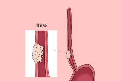 重庆肿瘤老中医:中医辨证治疗食管瘤,这3个方面你需要知道！