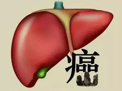 不想肝硬化发展成肝癌?中医辩证治疗为您抑制肿瘤生长