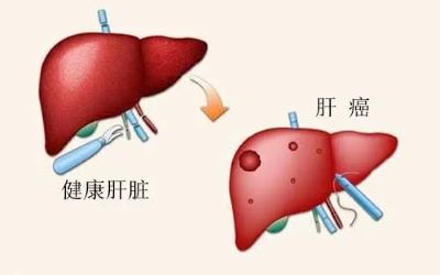 肝癌肺转移患者做了介入治疗问题多多,中医是这样治疗的！
