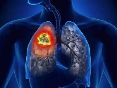 74岁的王奶奶一直胸闷,患肺癌多年的她就医经历值得所有人深思