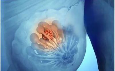 乳腺癌治疗期间应该“增体重”还是“减体重”?