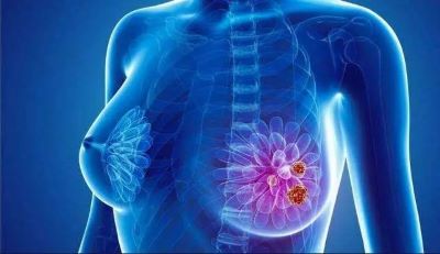 术后乳腺癌患者腋下和肩部疼痛,御和堂中医是这样缓解的