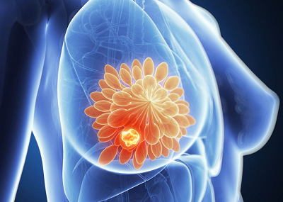 乳腺癌患者怎么做才能提高免疫力?重庆肿瘤医师这么回答的