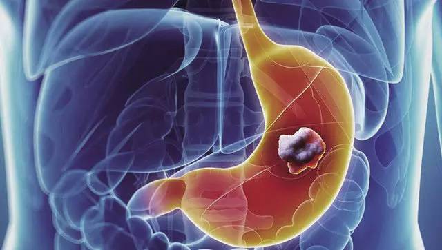 胃癌是什么病？胃癌能治愈吗？