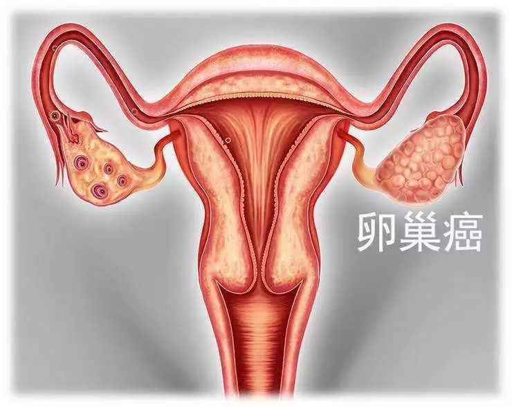 中医治疗卵巢癌有哪些好处？你知道吗？