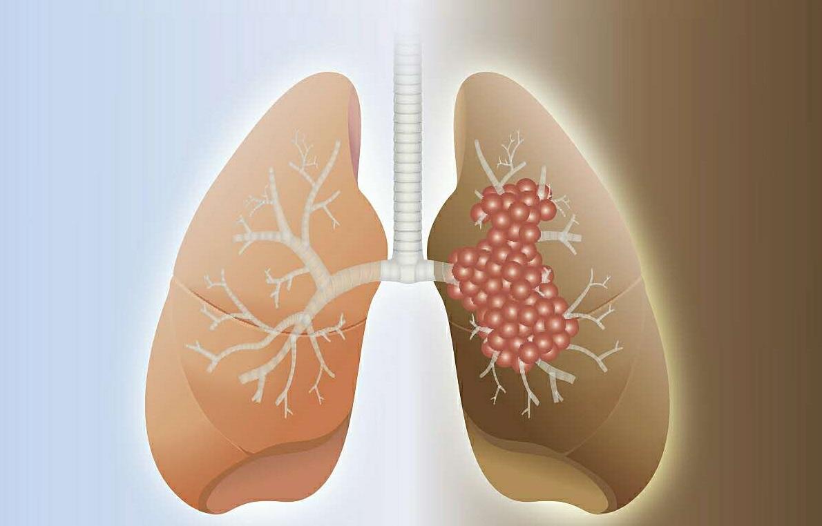 肺癌早期除咳嗽外 还伴随这3种“异常”症状！