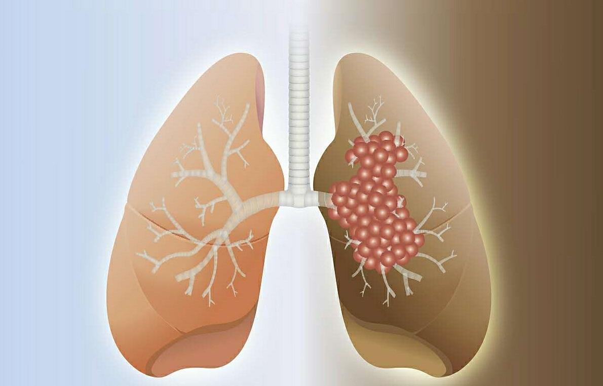 中医药联合化疗治疗肺癌的好处有哪些？你知道吗？